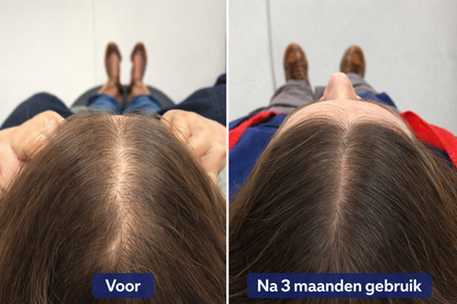 ScalpBoost™ – Hoofdhuid Massager